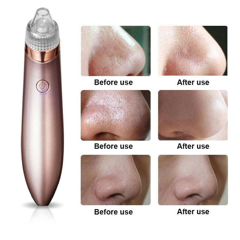 Chargeable Blackhead Removal Machine Black Head Remover Machine - Acne Pimple Pore Cleaner Vacuum Suction Tool Blackhead Removal On Nose Sucking Machine Blackheads Removal Device Derma Suction
